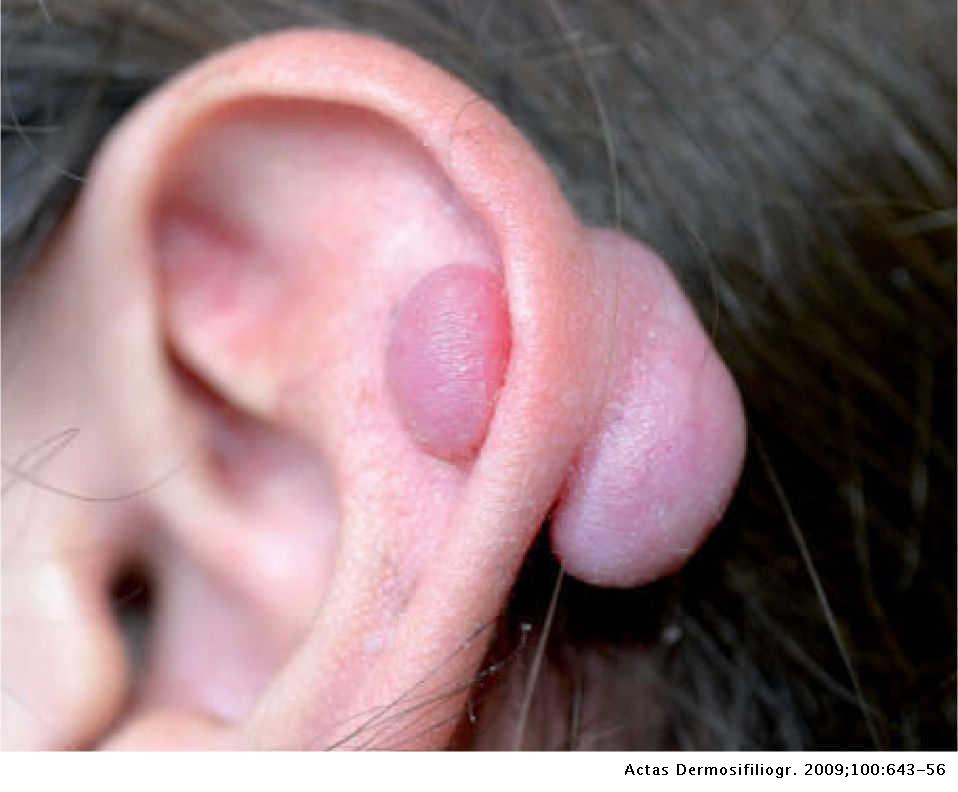 granuloma en la oreja